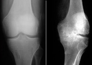 Métodos de diagnóstico de la osteoartritis
