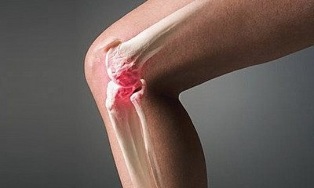 en qué se diferencia la artritis de la osteoartritis