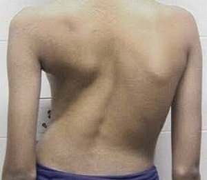 La escoliosis como causa de dolor de espalda