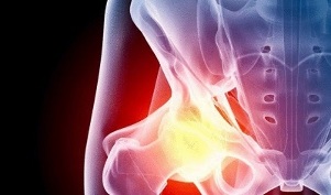 Causas del desarrollo de artrosis de cadera. 