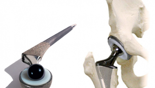 Endoprótesis de la articulación de la cadera en la osteoartritis
