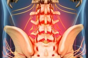 Causas y síntomas de la osteocondrosis