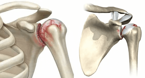 ¿Cómo se ve la osteoartritis de la articulación del hombro 