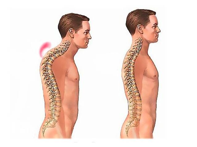 Cifosis espinal
