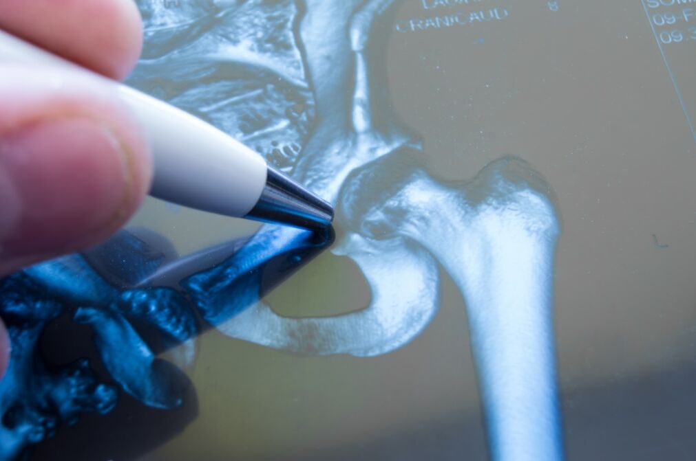 Artrosis de la articulación de la cadera en la radiografía. 