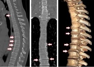 4. Grado de osteocondrosis torácica en la tomografía computarizada
