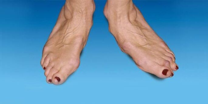 Malposición del pie en la artrosis del tobillo