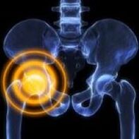 Artrosis de la articulación de la cadera