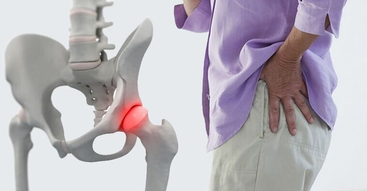 Dolor de cadera un síntoma de osteoartritis de la articulación de la cadera. 