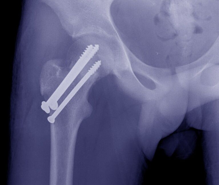 Radiografía de la articulación de la cadera, osteosíntesis de la fractura con fijadores internos. 