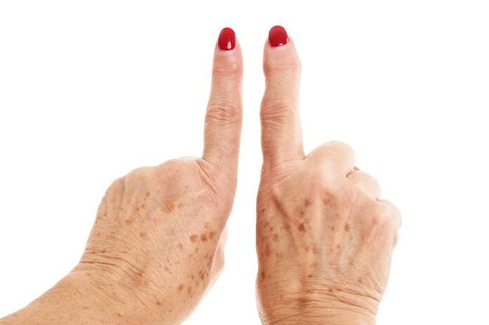 Deformación de la osteoartritis en los dedos. 