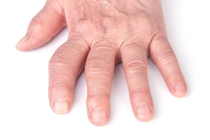deformación de la osteoartritis en las manos