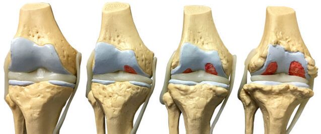 Daño articular en diversas etapas del desarrollo de la artrosis del tobillo