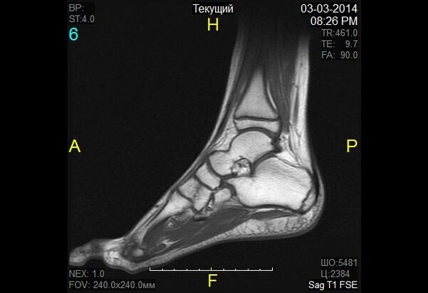 Imagen del tobillo en la osteoartritis