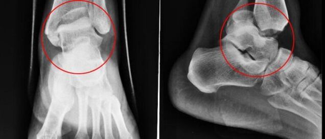 Radiografía para la artrosis de tobillo
