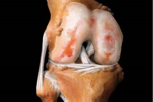 Daño a la articulación de la rodilla con osteoartritis. 