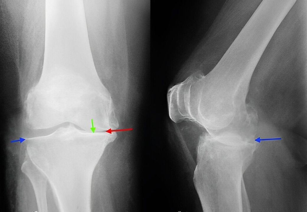Imagen de rayos X de la osteoartritis de la articulación de la rodilla. 