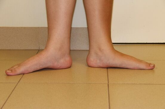 A veces los pies planos son la causa de la artrosis de cuello