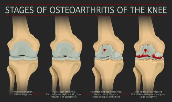 Desarrollo de artrosis articular.