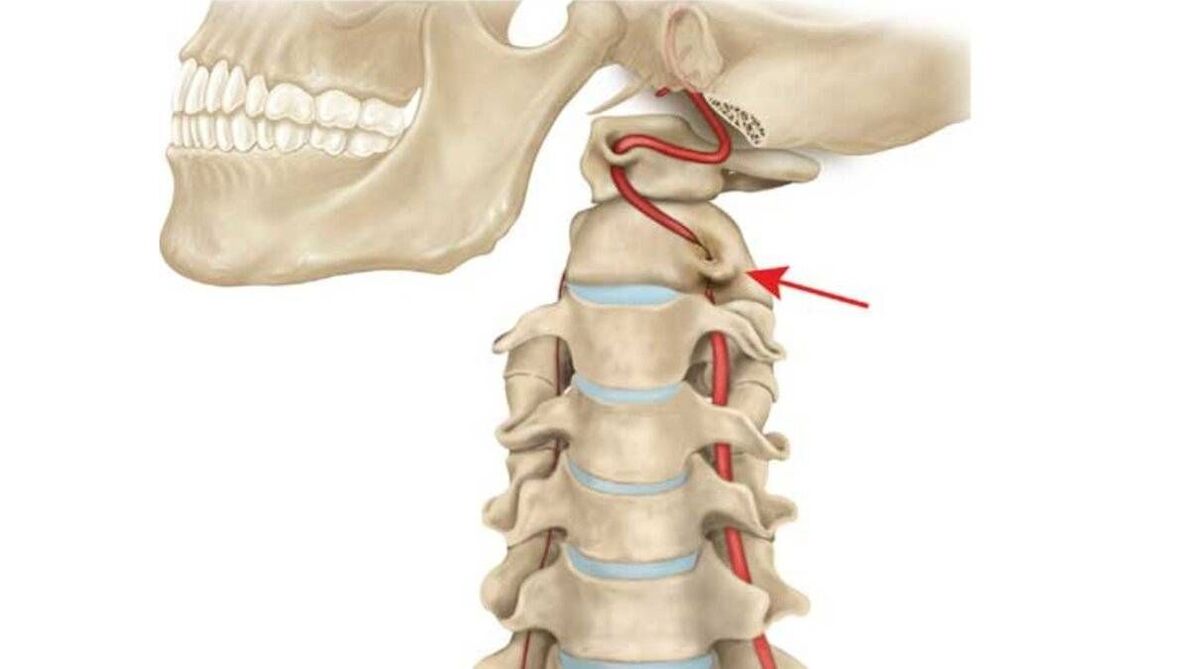 Osteocondrosis de la columna cervical.