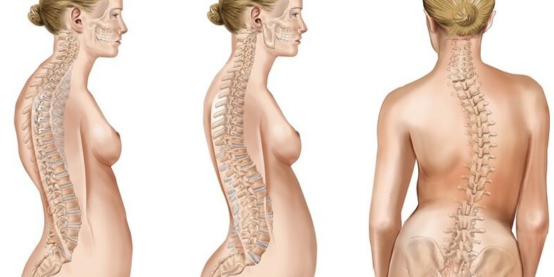 La escoliosis de la columna torácica provoca dolor en los omóplatos.