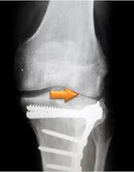Osteoartritis de la articulación de la rodilla.