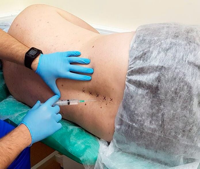 Bloqueos médicos para la espalda.