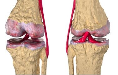 Las venas varicosas son la causa del desarrollo de gonartrosis.