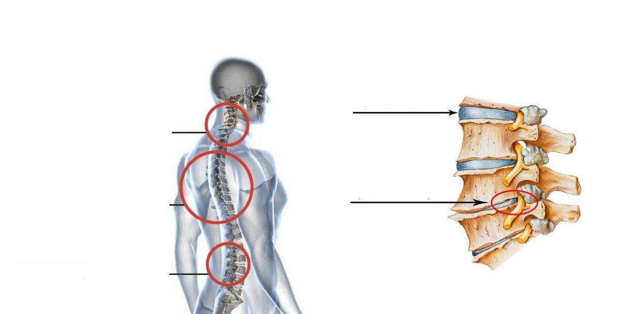 Osteocondrosis de la columna